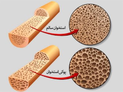 بهترین روش جلوگیری از پوکی استخوان!